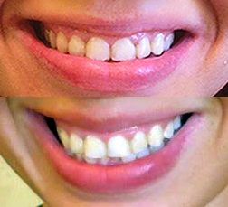 SmileBrilliant Before After Just Teeth