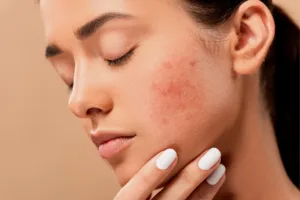 Acne Scar Removal Treatment Woman With Acne Scars
