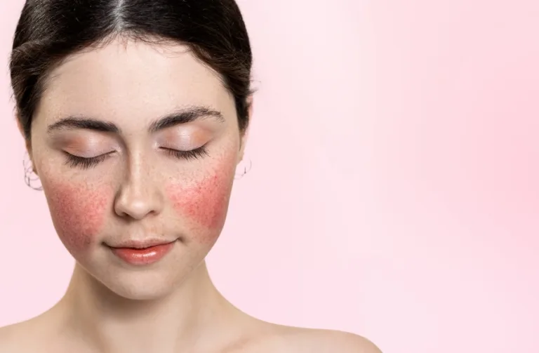 Diet and Rosacea: Exploring the Link Between Food Choices and Skin Health
