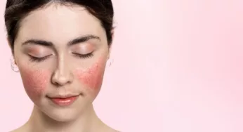 Diet and Rosacea: Exploring the Link Between Food Choices and Skin Health